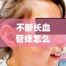 不断长血管痣怎么办？了解、应对与预防全攻略！